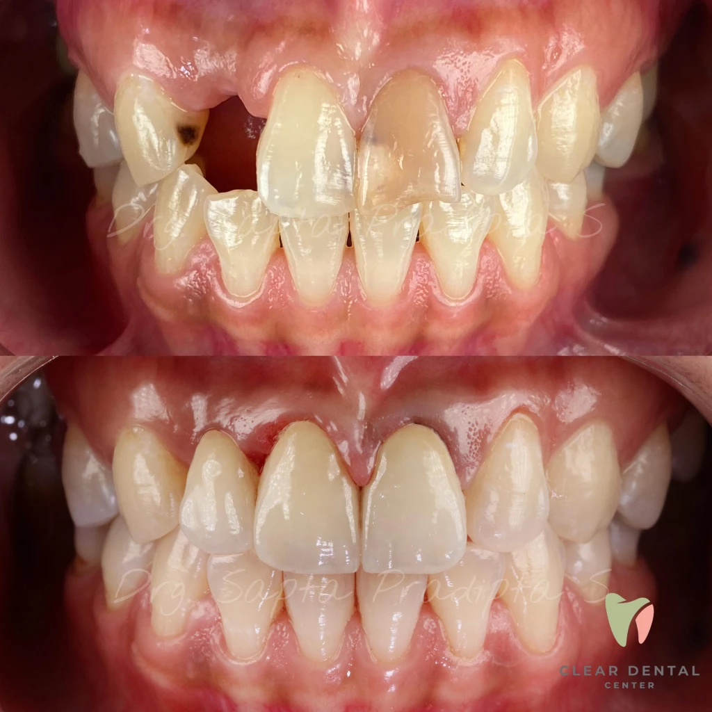 Perawatan Bridge Zirconia Estetik