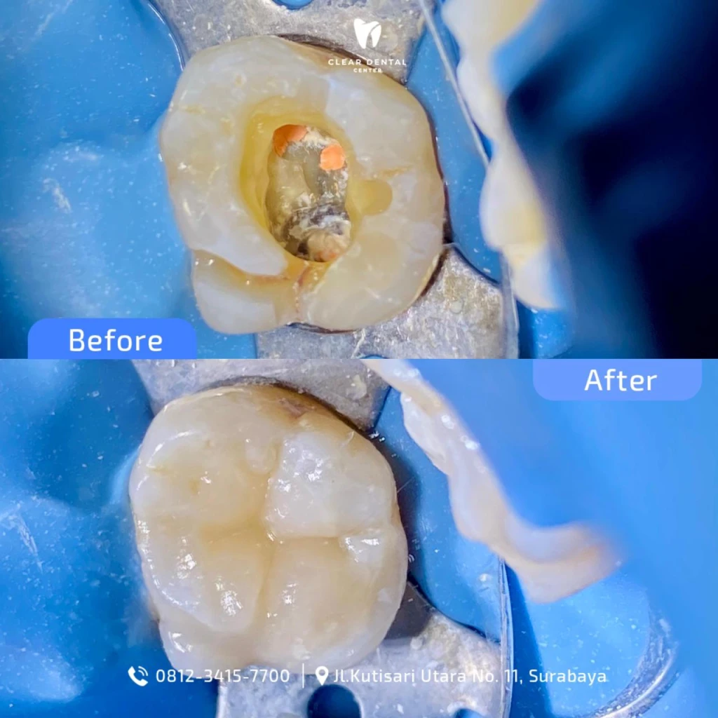 Perawatan Saluran Akar Gigi Geraham