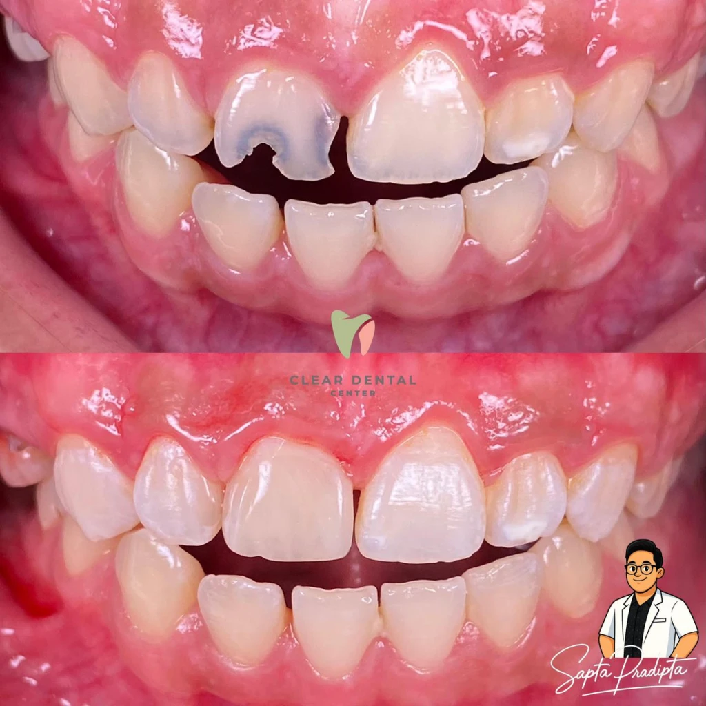 Tambal Estetik Gigi Depan