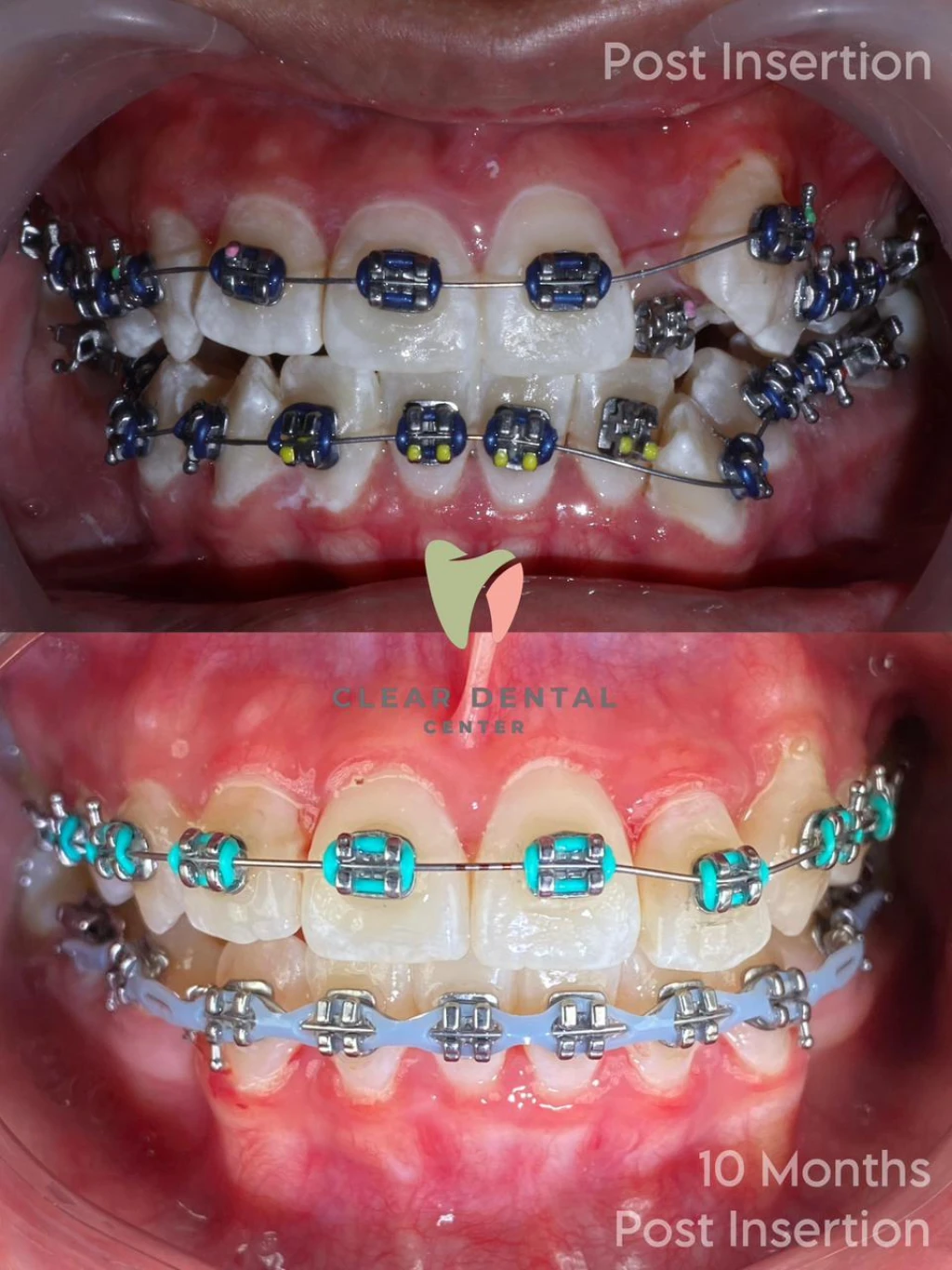 Perawatan Behel Metal USA