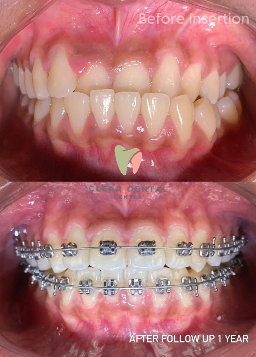 Perawatan Behel Metal USA