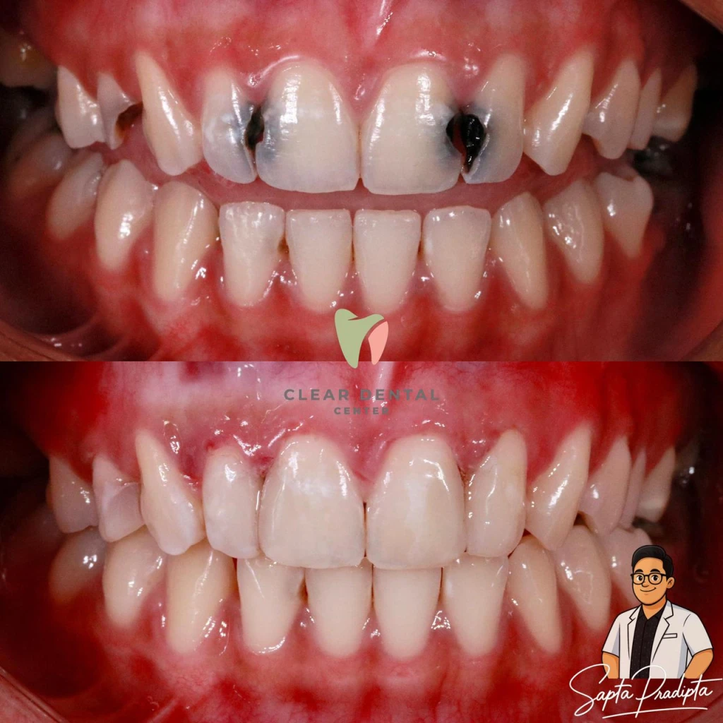 Perawatan Tambal Estetik 4 Gigi 1X Kunjungan