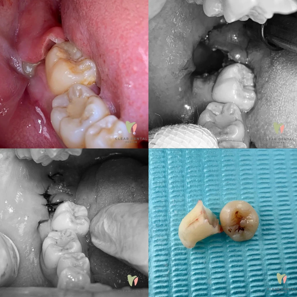 Odontektomi / Operasi Gigi Bungsu