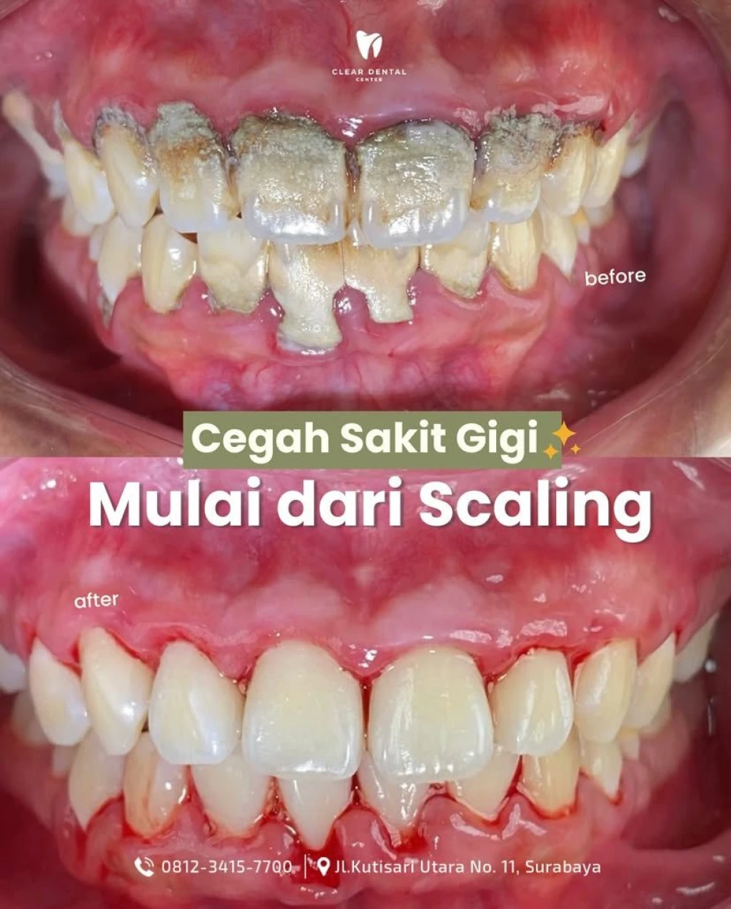 Scaling / Pembersihan Karang Gigi